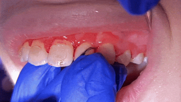 Child with braces smiling