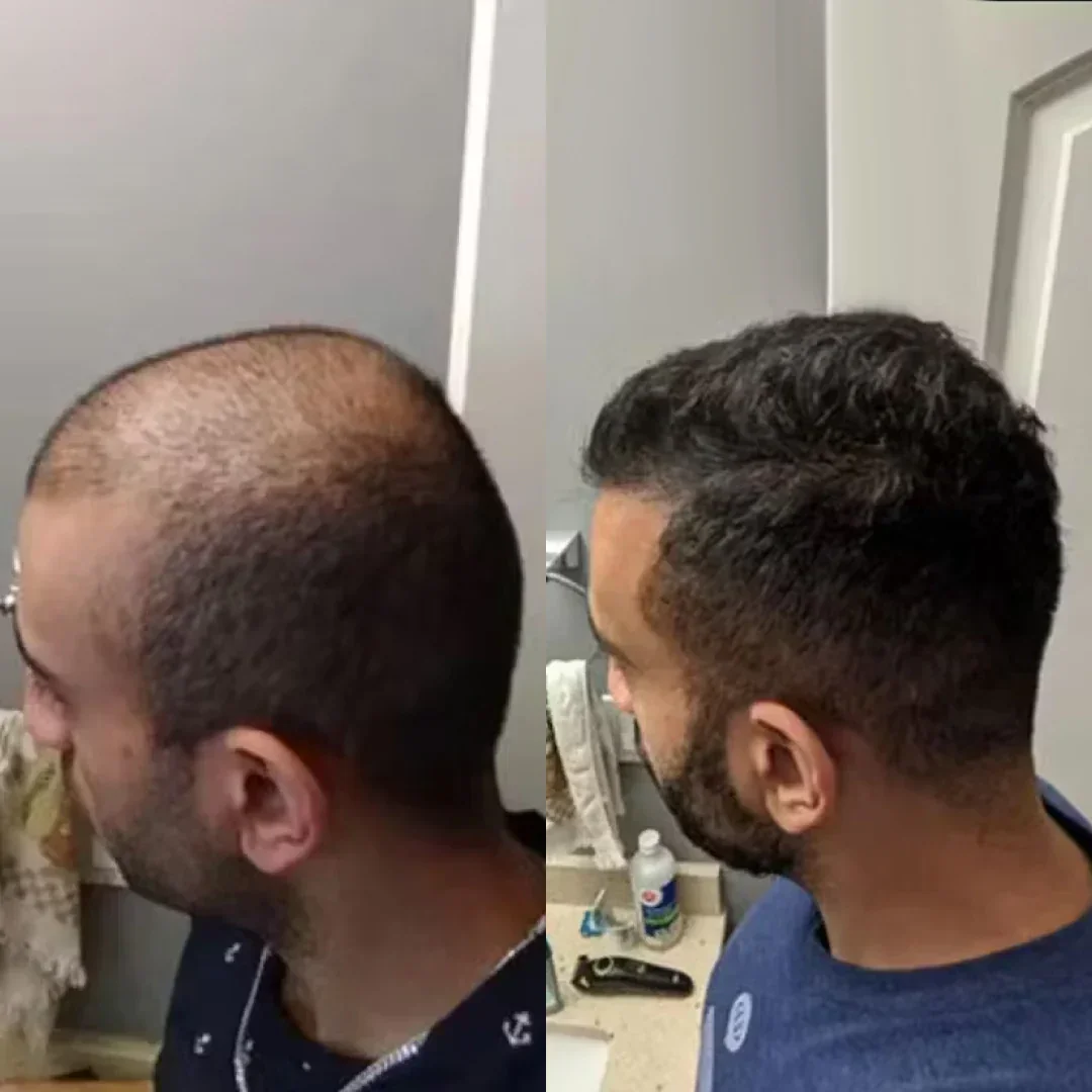 Transformation photo