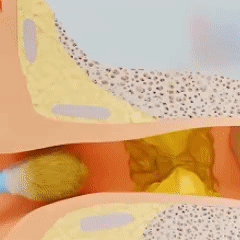 EarClear Pro™ | Clear Blockages & Ear Pressure in 60 Seconds 8 1765279962 GIF