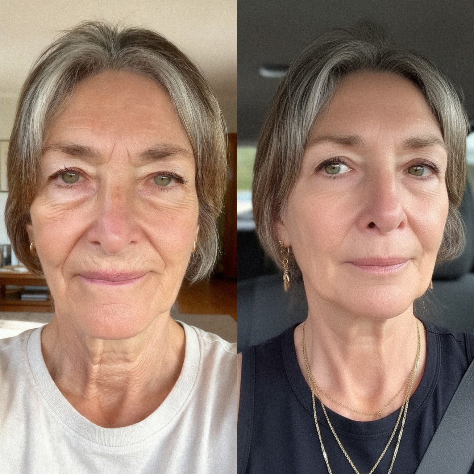 Three weeks of RVRS serum use