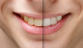 David testimonial VioSmile